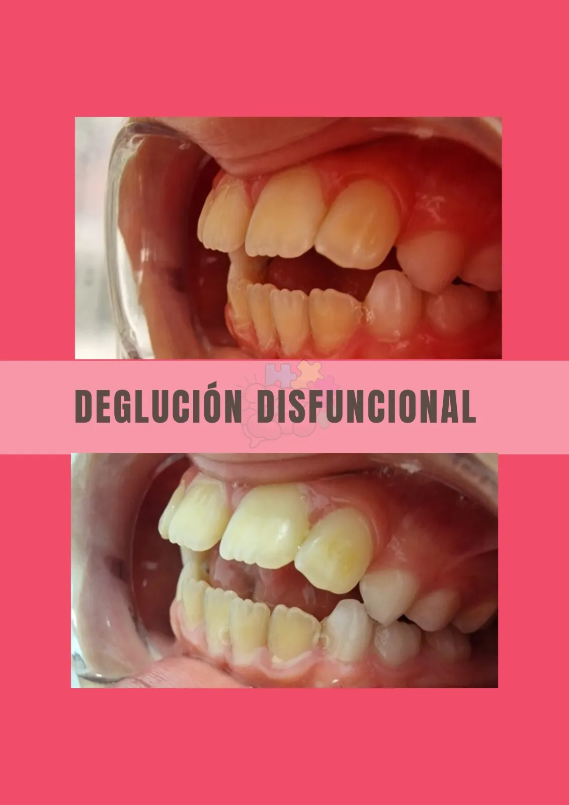 Deglución disfuncional - Evaluación