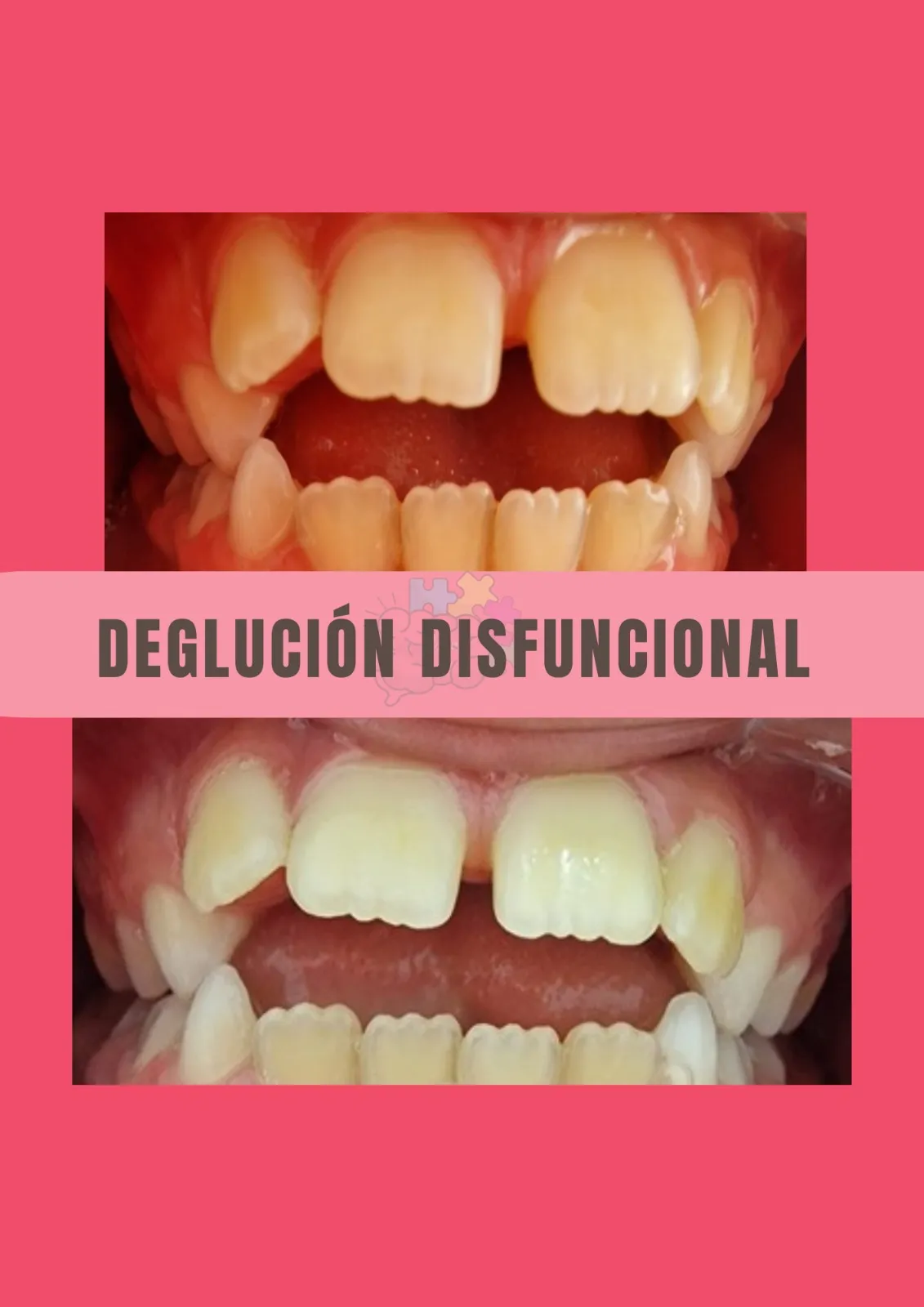 Deglución disfuncional - Tratamiento
