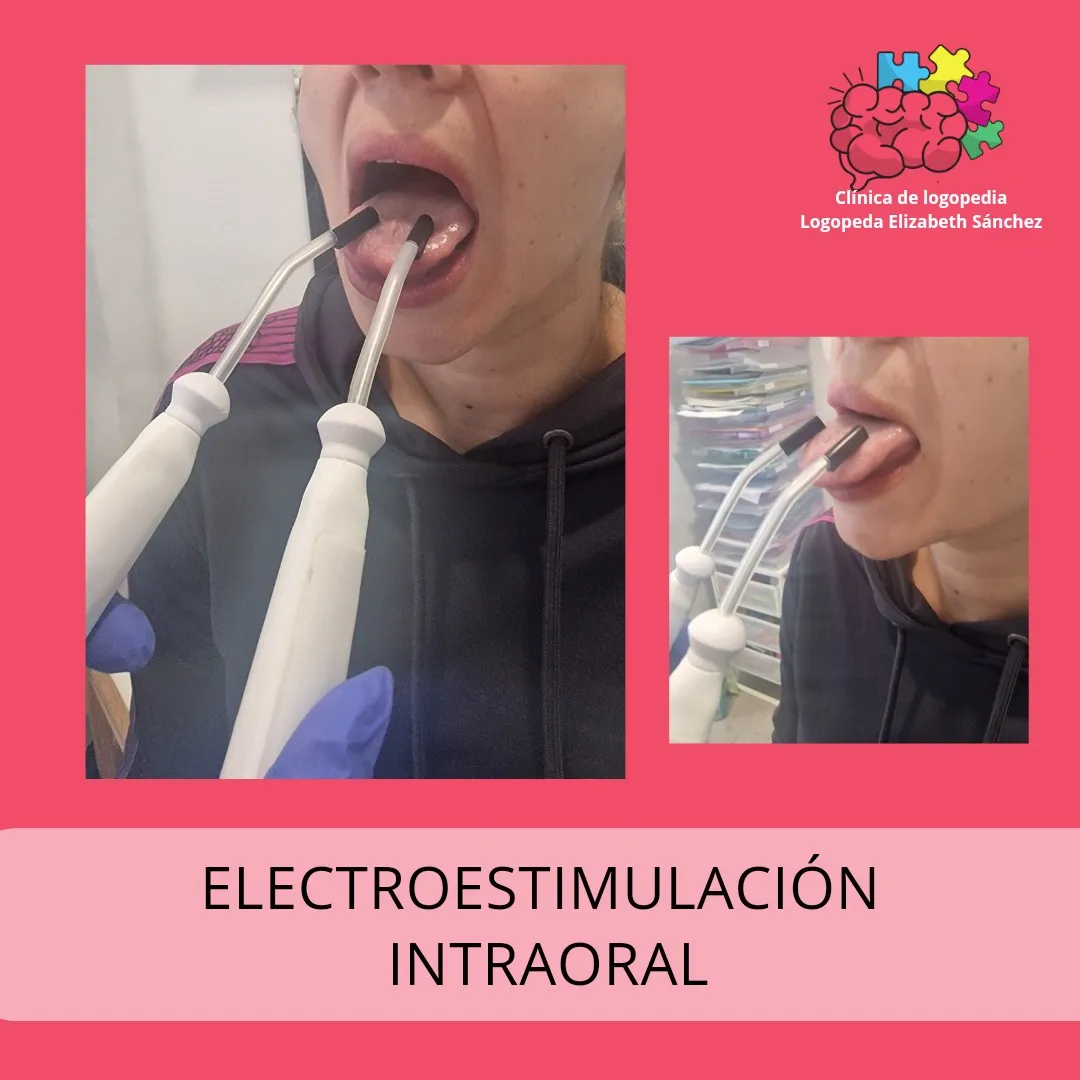 Electroestimulación intraoral