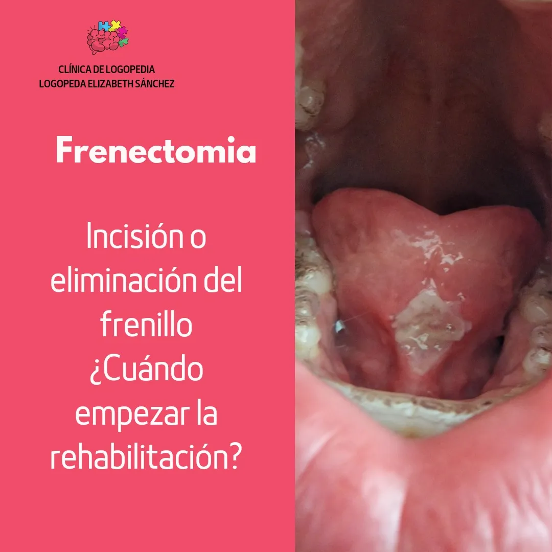 Frenectomía - Procedimiento del frenillo