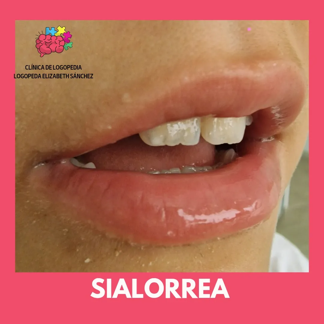 Tratamiento de sialorrea