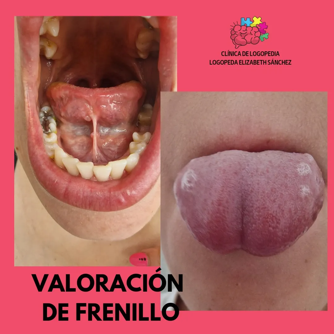 Valoración de frenillo